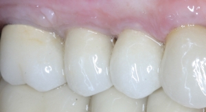 SINUS GRAFT PAGE Tuzzeo B